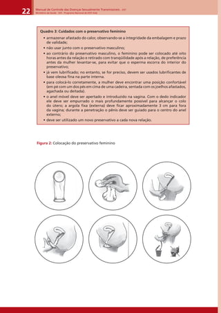Manual de Controle das Doenças Sexualmente Transmissíveis – DST
Ministério da Saúde - SVS - Programa Nacional de DST/ Aids22
Quadro 3: Cuidados com o preservativo feminino
• armazenar afastado do calor, observando-se a integridade da embalagem e prazo
de validade;
• não usar junto com o preservativo masculino;
• ao contrário do preservativo masculino, o feminino pode ser colocado até oito
horas antes da relação e retirado com tranqüilidade após a relação, de preferência
antes da mulher levantar-se, para evitar que o esperma escorra do interior do
preservativo;
• já vem lubriﬁcado; no entanto, se for preciso, devem ser usados lubriﬁcantes de
base oleosa ﬁna na parte interna.
• para colocá-lo corretamente, a mulher deve encontrar uma posição confortável
(em pé com um dos pés em cima de uma cadeira, sentada com os joelhos afastados,
agachada ou deitada).
• o anel móvel deve ser apertado e introduzido na vagina. Com o dedo indicador
ele deve ser empurrado o mais profundamente possível para alcançar o colo
do útero; a argola ﬁxa (externa) deve ﬁcar aproximadamente 3 cm para fora
da vagina; durante a penetração o pênis deve ser guiado para o centro do anel
externo;
• deve ser utilizado um novo preservativo a cada nova relação.
Figura 2: Colocação do preservativo feminino
 
