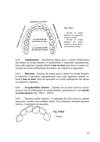 96
Fig. VIII,7
- Divisão da arcada
dentária em segmentos
laterais e incisal.
- Divisão da arcada
dentária em sector
anterior e sector poste-
rior da esfera oclusal.
8,42 – Apinhamento – Insuficiente espaço para o correto alinha-mento
dos dentes na arcada dentária. O apinhamento é registrado separadamente,
para cada segmento, quando faltam 2 mm ou mais para haver o espaço ne-
cessário ao correto alinhamento dos dentes, nos respectivos segmentos.
8,43 – Diastema – Excesso de espaço para os dentes na arcada dentária.
O diastema é registrado, separadamente, para cada segmento, quando so-
brem 2 mm ou mais, além do necessário ao correto alinhamento dos dentes
no respectivo segmento.
8,44 – Irregularidade anterior – Quando um ou mais incisivos encon-
tram-se fora do alinhamento da arcada dentária, apresentam-se com rotação
ou deslocamento (Fig. VIII,8 – VIII.9).
8,45 – Diastema médio superior - A separação dos dois incisivos centrais
superiores constitui uma entidade clínica. Esse diastema, chamado diastema
incisivo, é registrado em separado.
Fig. VIII,8
— Rotação
 