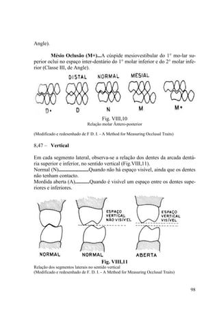 98
Angle).
Mésio Oclusão (M+)...A cúspide mesiovestibular do 1° mo-lar su-
perior oclui no espaço inter-dentário do 1° molar inferior e do 2° molar infe-
rior (Classe III, de Angle).
Fig. VIII,10
Relação molar Ântero-posterior
(Modificado e redesenhado de F D. I. - A Method for Measuring Occlusal Traits)
8,47 – Vertical
Em cada segmento lateral, observa-se a relação dos dentes da arcada dentá-
ria superior e inferior, no sentido vertical (Fig.VIII,11).
Normal (N).......................Quando não há espaço visível, ainda que os dentes
não tenham contacto.
Mordida aberta (A)...........Quando é visível um espaço entre os dentes supe-
riores e inferiores.
Fig. VIII,11
Relação dos segmentos laterais no sentido vertical
(Modificado e redesenhado de F. D. I. - A Method for Measuring Occlusal Traits)
 