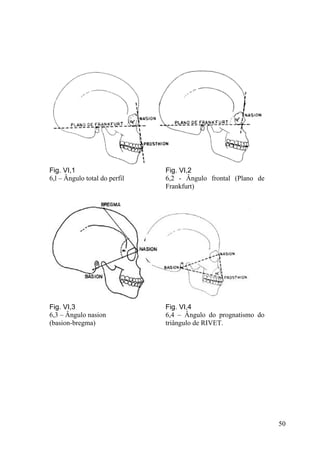 50
Fig. VI,1
6,l – Ângulo total do perfil
Fig. VI,2
6,2 - Ângulo frontal (Plano de
Frankfurt)
Fig. VI,3
6,3 – Ângulo nasion
(basion-bregma)
Fig. VI,4
6,4 – Ângulo do prognatismo do
triângulo de RIVET.
 