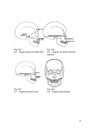 51
Fig. VI,5
6,5 – Ângulo facial de JAQUART
Fig. VI,6
6,6 – Ângulo do perfil alveolar
superior
Fig. VI,7
6,7 – Ângulo do perfil nasal
Fig. VI,8
6,8 – Ângulo zigo-maxilar
 