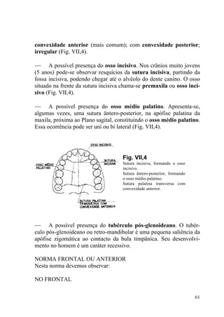 61
convexidade anterior (mais comum); com convexidade posterior;
irregular (Fig. VII,4).
— A possível presença do osso incisivo. Nos crânios muito jovens
(5 anos) pode-se observar resquícios da sutura incisiva, partindo da
fossa incisiva, podendo chegar até o alvéolo do dente canino. O osso
situado na frente da sutura incisiva chama-se premaxila ou osso inci-
sivo (Fig. VII,4).
— A possível presença do osso médio palatino. Apresenta-se,
algumas vezes, uma sutura ântero-posterior, na apófise palatina da
maxila, próxima ao Plano sagital, constituindo o osso médio palatino.
Essa ocorrência pode ser uni ou bi lateral (Fig. VII,4).
Fig. VII,4
Sutura incisiva, formando o osso
incisivo.
Sutura ântero-posterior, formando
o osso médio palatino.
Sutura palatina transversa com
convexidade anterior.
— A possível presença do tubérculo pós-glenoideano. O tubér-
culo pós-glenoideano ou retro-mandibular é uma pequena saliência da
apófise zigomática ao contacto da bula timpânica. Seu desenvolvi-
mento no homem é um caráter recessivo.
NORMA FRONTAL OU ANTERIOR
Nesta norma devemos observar:
NO FRONTAL
 