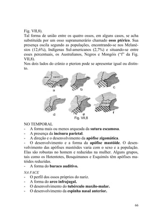 66
Fig. VII,8).
Tal forma de união entre os quatro ossos, em alguns casos, se acha
substituída por um osso supranumerário chamado osso ptérico. Sua
presença oscila segundo as populações, encontrando-se nos Melané-
sios (12,6%), Indígenas Sul-americanos (2,7%) e situando-se entre
esses percentuais, os Australianos, Negros e Mongóis (“f” da Fig.
VII,8).
Nos dois lados do crânio o pterion pode se apresentar igual ou distin-
to.
Fig. VII,8
NO TEMPORAL
- A forma mais ou menos arqueada da sutura escamosa.
- A presença da incisura parietal.
- A direção e o desenvolvimento da apófise zigomática.
- O desenvolvimento e a forma da apófise mastóide. O desen-
volvimento das apófises mastóides varia com o sexo e a população.
Elas são robustas no homem e reduzidas na mulher. Alguns grupos,
tais como os Hotentotes, Bosquimanos e Esquimós têm apófises ma-
tóides reduzidas.
- A forma do buraco auditivo.
NA FACE
- O perfil dos ossos próprios do nariz.
- A forma do arco infrajugal.
- O desenvolvimento do tubérculo maxilo-malar.
- O desenvolvimento da espinha nasal anterior.
 