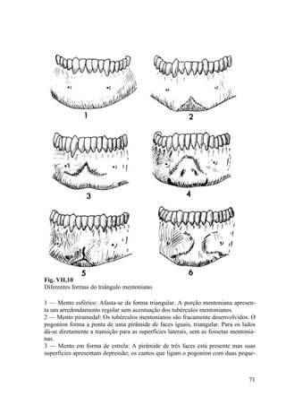 71
Fig. VII,10
Diferentes formas do triângulo mentoniano.
1 — Mento esférico: Afasta-se da forma triangular. A porção mentoniana apresen-
ta um arredondamento regular sem acentuação dos tubérculos mentonianos.
2 — Mento piramedal: Os tubérculos mentonianos são fracamente desenvolvidos. O
pogonion forma a ponta de uma pirâmide de faces iguais, triangular. Para os lados
dá-se diretamente a transição para as superfícies laterais, sem as fossetas mentonia-
nas.
3 — Mento em forma de estrela: A pirâmide de três faces está presente mas suas
superfícies apresentam depressão; os cantos que ligam o pogonion com duas peque-
 