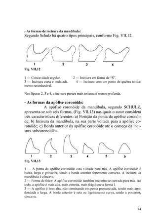 74
- As formas de incisura da mandíbula:
Segundo Schulz há quatro tipos principais, conforme Fig. VII,12.
Fig. VII,12
1 — Concavidade regular. 2 — Incisura em forma de “S”.
3 — Incisura curta e ondulada. 4 — Incisura com um ponto de quebra nitida-
mente reconhecível.
Nas figuras 2, 3 e 4, a incisura parece mais extensa e menos profunda.
- As formas da apófise coronóide:
A apófise coronóide da mandíbula, segundo SCHULZ,
apresenta-se sob seis formas, (Fig. VII,13) nas quais o autor considera
três características diferentes: a) Posição da ponta da apófise coronói-
de; b) Incisura da mandíbula, na sua parte voltada para a apófise co-
ronóide; c) Borda anterior da apófise coronóide até o começo da inci-
sura subcoronoidéia.
Fig. VII,13
1 — A ponta da apófise coronóide está voltada para trás. A apófise coronóide é
baixa, larga e grosseira, sendo a borda anterior fortemente convexa. A incisura da
mandíbula é côncava.
2 — Forma de foice: A apófise coronóide também encontra-se curvada para trás. Ao
todo, a apófise é mais alta, mais estreita, mais frágil que a forma l.
3 — A apófise é bem alta, não terminando em ponta pronunciada, sendo mais arre-
dondada e larga. A borda anterior é reta ou ligeiramente curva, sendo a posterior,
côncava.
 