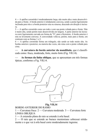 75
4 — A apófise coronóide é moderadamente larga, não muito alta e mais desenvolvi-
da para a frente. A borda anterior é nitidamente convexa, sendo a ponta ligeiramente
inclinada para trás e a borda posterior reta ou sinuosa, descendo em direção à incisu-
ra.
5 — A apófise coronóide como um todo e com sua ponta voltada para a frente. Não
é muito alta, sendo porém mais desenvolvida em largura. A parte anterior da incisu-
ra corre ligeiramente curvada em forma de "S", para o Koronion. A borda anterior é
reta ou levemente convexa. A convexidade volta-se, porém, mais para a frente, em
contraste com as formas 1 e 2.
6 — A apófise coronóide forma um triângulo, não sendo ao todo muito alta. As
bordas anterior e posterior, na maioria das vezes, são retas com a ponta voltada para
cima.
— A curvatura do bordo anterior da mandíbula, que é classifi-
cada como: fraca, moderada, forte, muito forte (Fig. VII.14).
— As formas da linha oblíqua, que se apresentam em três formas
típicas, conforme a Fig. VII,14.
Fig. VII,14
BORDO ANTERIOR DO RAMO
1 — Curvatura fraca 2 — Curvatura moderada 3 — Curvatura forte
LINHA OBLÍQUA
1 — A extensão plana do raio se estende à orla basal.
2 — O raio que se estende ao buraco mentoniano sobressai nitida-
mente e o que vai à orla basal corre moderadamente íngreme.
 