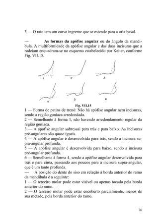 76
3 — O raio tem um curso íngreme que se estende para a orla basal.
— As formas da apófise angular ou do ângulo da mandí-
bula. A multiformidade da apófise angular e das duas incisuras que a
rodeiam enquadram-se no esquema estabelecido por Keiter, conforme
Fig. VII.15.
Fig. VII,15
1 — Forma de patins de trenó: Não há apófise angular nem incisuras,
sendo a região goníaca arredondada.
2 — Semelhante à forma 1, não havendo arredondamento regular da
região goníaca.
3 — A apófise angular sobressai para trás e para baixo. As incisuras
pré-angulares são quase iguais.
4 — A apófise angular é desenvolvida para trás, sendo a íncisura su-
pra-angular profunda.
5 — A apófise angular é desenvolvida para baixo, sendo a incisura
pré-angular profunda.
6 — Semelhante à forma 4, sendo a apófise angular desenvolvida para
trás e para cima, passando aos poucos para a incisura supra-angular,
que é um tanto profunda.
— A posição do dente do siso em relação à borda anterior do ramo
da mandíbula é a seguinte:
1 — O terceiro molar pode estar visível ou apenas tocado pela borda
anterior do ramo.
2 — O terceiro molar pode estar encoberto parcialmente, menos de
sua metade, pela borda anterior do ramo.
 