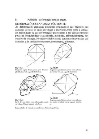 81
h) Polinésia - deformação tabular erecta.
DEFORMAÇÕES CRANIANAS PÓS-MORTE
As deformações cranianas póstumas originam-se das pressões das
camadas do solo, as quais envolvem o indivíduo, bem como a umida-
de. Distinguem-se das deformações patológicas e das causas culturais
pela sua irregularidade e assimetria, incidindo, primordialmente, nos
crânios de crianças. No crânio adulto a ação conjunta das pressões das
camadas e da umidade conduzem, comumente, a fraturas.
Fig. VII,16
Diagrama sagital de um crânio com deforma-
ção tabular erecta segundo Imbelloni.
Fig. VII,17
Diagrama sagital de um crânio com deforma-
ção tabular obliqua, segundo Imbelloni.
Fig. VII,18
Perfil de um crânio com deformação anelar,
variedade obliqua, segundo Imbelloni.
Fig. VII,19
Diagrama sagital de um crânio com deforma-
ção anelar variedade erecta segundo Imbello-
ni.
Redesenhados do Manual de Juan Comas, Antropologia Física.
 