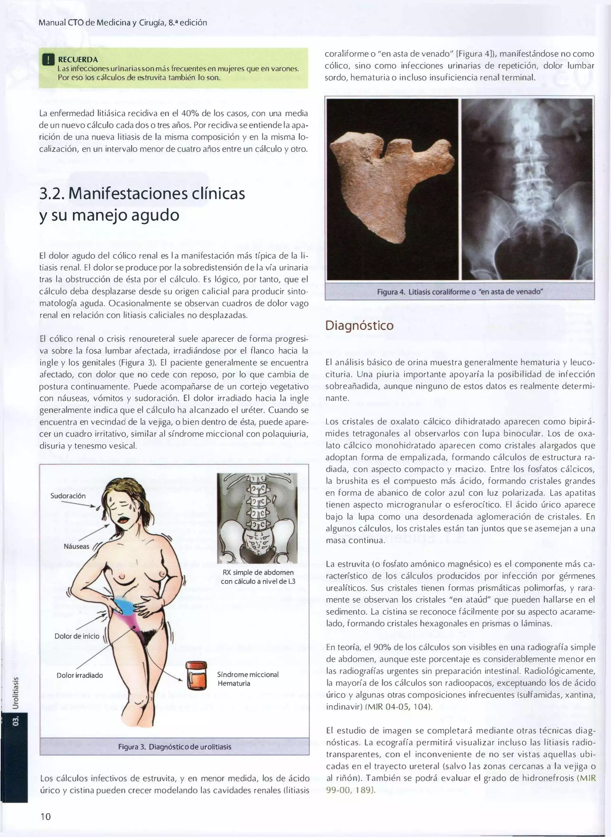 Manual eTO de Medicina y Cirugía, B.a edición

o RECUERDA

coraliforme o "en asta de venado" [Figura 4]), manifestándose no como

las infecciones urinarias son más frecuentes en mujeres que en varones.
Por eso los cálculos de estruvita también lo son.

cólico, sino como infecciones urinarias de repetición, dolor lumbar
sordo, hematuria o incluso insuficiencia renal terminal.

La enfermedad litiásica recidiva en el 40% de los casos, con una media
de un nuevo cálculo cada dos o tres años. Por recidiva se entiende la apa­
rición de una nueva litiasis de la misma composición y en la misma lo­
calización, en un intervalo menor de cuatro años entre un cálculo y otro.

3.2. M a n ifestaciones c l ín i cas

y su manejo a g u d o
El dolor agudo del cólico renal es l a manifestación más típica de la li­
tiasis renal. El dolor se produce por la sobredistensión de la vía urinaria
tras la obstrucción de ésta por el cálculo. Es lógico, por tanto, que el
cálculo deba desplazarse desde su origen calicial para producir sinto­
matología aguda. Ocasionalmente se observan cuadros de dolor vago
renal en relación con litiasis caliciales no desplazadas.

Diagnóstico

El cólico renal o crisis renoureteral suele aparecer de forma progresi­
va sobre la fosa lumbar afectada, irradiándose por el flanco hacia la
ingle y los genitales (Figura 3). El paciente generalmente se encuentra

El análisis básico de orina muestra generalmente hematuria y leuco­

afectado, con dolor que no cede con reposo, por lo que cambia de

cituria. Una piuria importante apoyaría la posibil idad de infección

postura continuamente. Puede acompañarse de un cortejo vegetativo
con náuseas, vómitos y sudoración. El dolor irradiado hacia la ingle

sobreañadida, aunque ninguno de estos datos es realmente determi­
nante.

generalmente indica que el cálculo ha alcanzado el uréter. Cuando se
encuentra en vecindad de la vejiga, o bien dentro de ésta, puede apare­

Los cristales de oxalato cálcico d i h idralado aparecen como bipirá­

cer un cuadro irritativo, similar al síndrome miccional con polaquiuria,

mides tetragonales a l observarlos con lupa b i nocular. Los de oxa­
lato cálcico monohidratado aparecen como cristales alargados que

disuria y tenesmo vesical.

adoptan forma de empalizada, formando cálculos de estructura ra­
diada, con aspecto compacto y macizo. Entre los fosfatos cálcicos,
la brushita es el compuesto más ácido, formando cristales grandes
en forma de abanico de color azul con luz polarizada. Las apatitas

Sudoración

tienen aspecto microgranular o esferocítico. El ácido úrico aparece
bajo la lupa como una desordenada aglomeración de cristales. En
algunos cálculos, los cristales están tan juntos que se asemejan a u n a
masa continua.

RX simple de abdomen
con cálculo a nivel de l3

La estruvita (o fosfato amónico magnésico) es el componente más ca­
racterístico de los cálculos producidos por infección por gérmenes
urealíticos. Sus cristales tienen formas prismáticas polimorfas, y rara­
mente se observan los cristales "en ataúd" que pueden hal larse en el
sedimento. La cistina se reconoce fácilmente por su aspecto acarame­
lado, formando cristales hexagonales en prismas o láminas.

Dolor de inicio

En teoría, el 90% de los cálculos son visibles en una radiografía simple
de abdomen, aunque este porcentaje es considerablemente menor en
Dolor irradiado

Síndrome miccional
Hematuria

las radiografías urgentes sin preparación intestinal. Radiológicamente,
la mayoría de los cálculos son radioopacos, exceptuando los de ácido
úrico y algunas otras composiciones infrecuentes (sulfamidas, xantina,
indinavir) (MIR 04-05, 1 04).

El estudio de imagen se completará mediante otras técnicas diag­
Figura 3. Diagnóstico de urolitiasis

nósticas. La ecografía permitirá visualizar incluso las l itiasis radio­
transparentes, con el inconveniente de no ser vistas aquellas ubi­
cadas en el trayecto ureteral (salvo las zonas cercanas a la vejiga o

Los cálculos infectivos de estruvita, y en menor medida, los de ácido

al riñón). También se podrá evaluar el grado de hidronefrosis ( M I R

úrico y cistina pueden crecer modelando las cavidades renales ( l itiasis

99-00, 1 89).

10

 