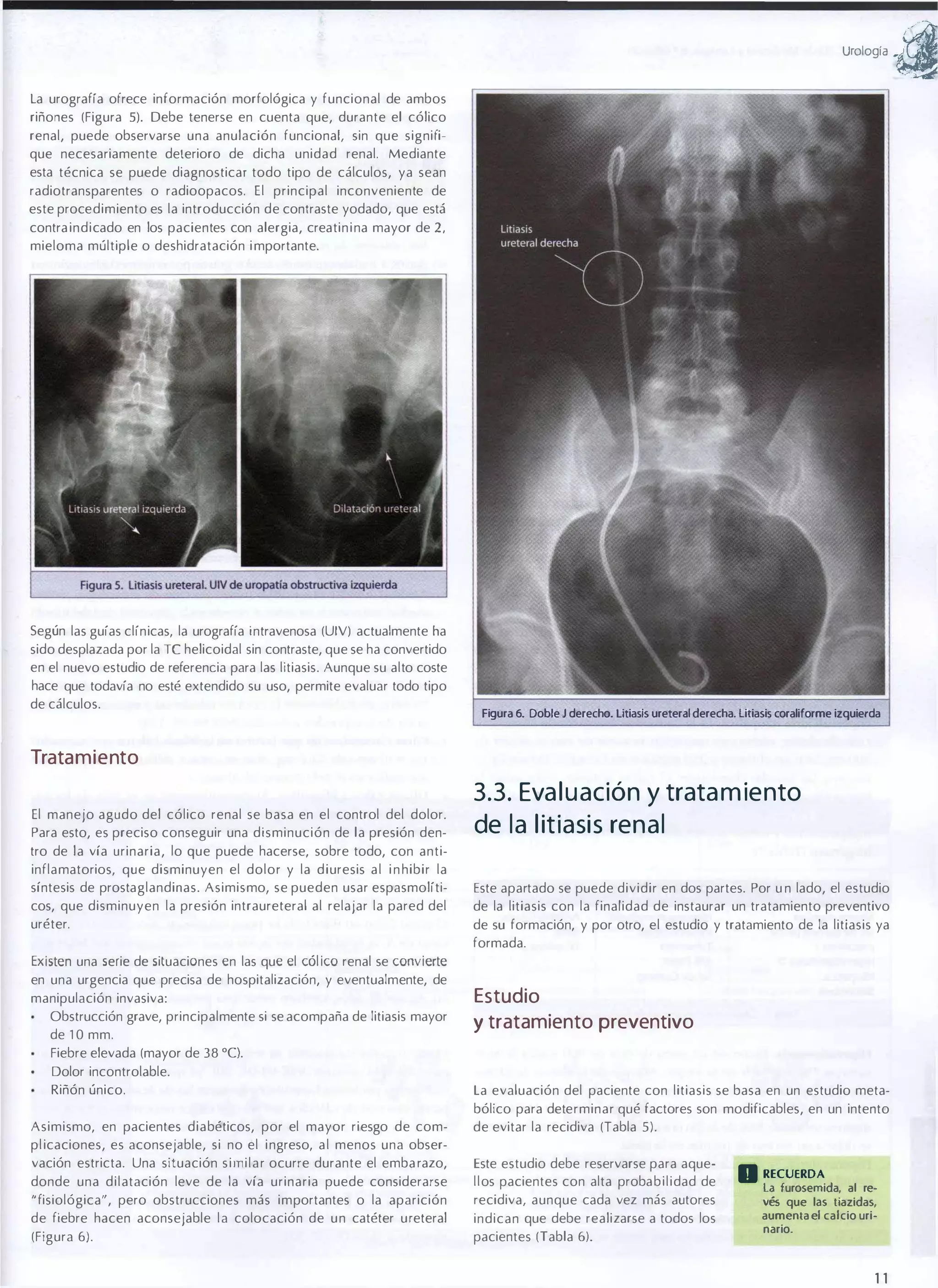 urolOgia �
La urograffa ofrece información morfológica y funcional de ambos
riñones (Figura 5). Debe tenerse en cuenta que, durante el cólico
renal, puede observarse una anulación funcional, sin que signifi­
que necesariamente deterioro de dicha unidad renal. Mediante
esta técnica se puede diagnosticar todo tipo de cálculos, ya sean
radiotransparentes o radioopacos. El principal inconveniente de
este procedimiento es la introducción de contraste yodado, que está
contra indicado en los pacientes con alergia, creatin i na mayor de 2,
mieloma múltiple o deshidratación i mportante.

Según las guías clínicas, la urografía intravenosa (UIV) actualmente ha
sido desplazada por la Te helicoidal sin contraste, que se ha convertido
en el nuevo estudio de referencia para las litiasis. Aunque su alto coste
hace que todavía no esté extendido su uso, permite evaluar todo tipo
de cálculos.

Figura 6. Doble J derecho. litiasis ureteral derecha. litiasis coraliforme izquierda

Tratamiento
El manejo agudo del cólico renal se basa en el control del dolor.
Para esto, es preciso conseguir una disminución de la presión den­

3.3. Eva l u ación y trata m iento
de l a l itiasis ren a l

tro de la vía urinaria, Jo que puede hacerse, sobre todo, con anti­
inflamatorios, que disminuyen el dolor y la d iuresis a l i n hibir la
síntesis de prostaglandinas. Asimismo, se pueden usar espasmolíti­
cos, que disminuyen la presión intraureteral al relajar la pared del
uréter.

Este apartado se puede dividir en dos partes. Por u n lado, el estudio
de la litiasis con la finalidad de instaurar un tratamiento preventivo
de su formación, y por otro, el estudio y tratamiento de la litiasis ya
formada.

Existen una serie de situaciones en las que el cólico renal se convierte

en una urgencia que precisa de hospitalización, y eventualmente, de
manipulación invasiva:
Obstrucción grave, principalmente si se acompaña de litiasis mayor
de 1 0 mm.

Estudio
y tratamiento preventivo

Fiebre elevada (mayor de 38 OC).
Dolor incontrolable.
Riñón único.
Asimismo, en pacientes diabéticos, por el mayor riesgo de com­

La evaluación del paciente con litiasis se basa en un estudio meta­
bólico para determinar qué factores son modificables, en un intento
de evitar la recidiva (Tabla 5).

pl icaciones, es aconsejable, si no el i ngreso, a l menos una obser­
vación estricta. Una situación s i m i l a r ocurre durante el emba razo,
donde una dilatación leve de la vía urinaria puede considerarse

Este estudio debe reservarse para aque­
l l os pacientes con alta proba b i l idad de

" fisiológica", pero obstrucciones más importantes o la aparición

recidiva, aunque cada vez más autores

de fiebre hacen aconsejable l a colocación de u n catéter u reteral

indican que debe realizarse a todos Jos
pacientes (Tabla 6).

(Figura 6).

a RECUERDA

la furosemida, al re­
vés que las tiazidas,

aumenta el calcio uri­
nario.

11

 