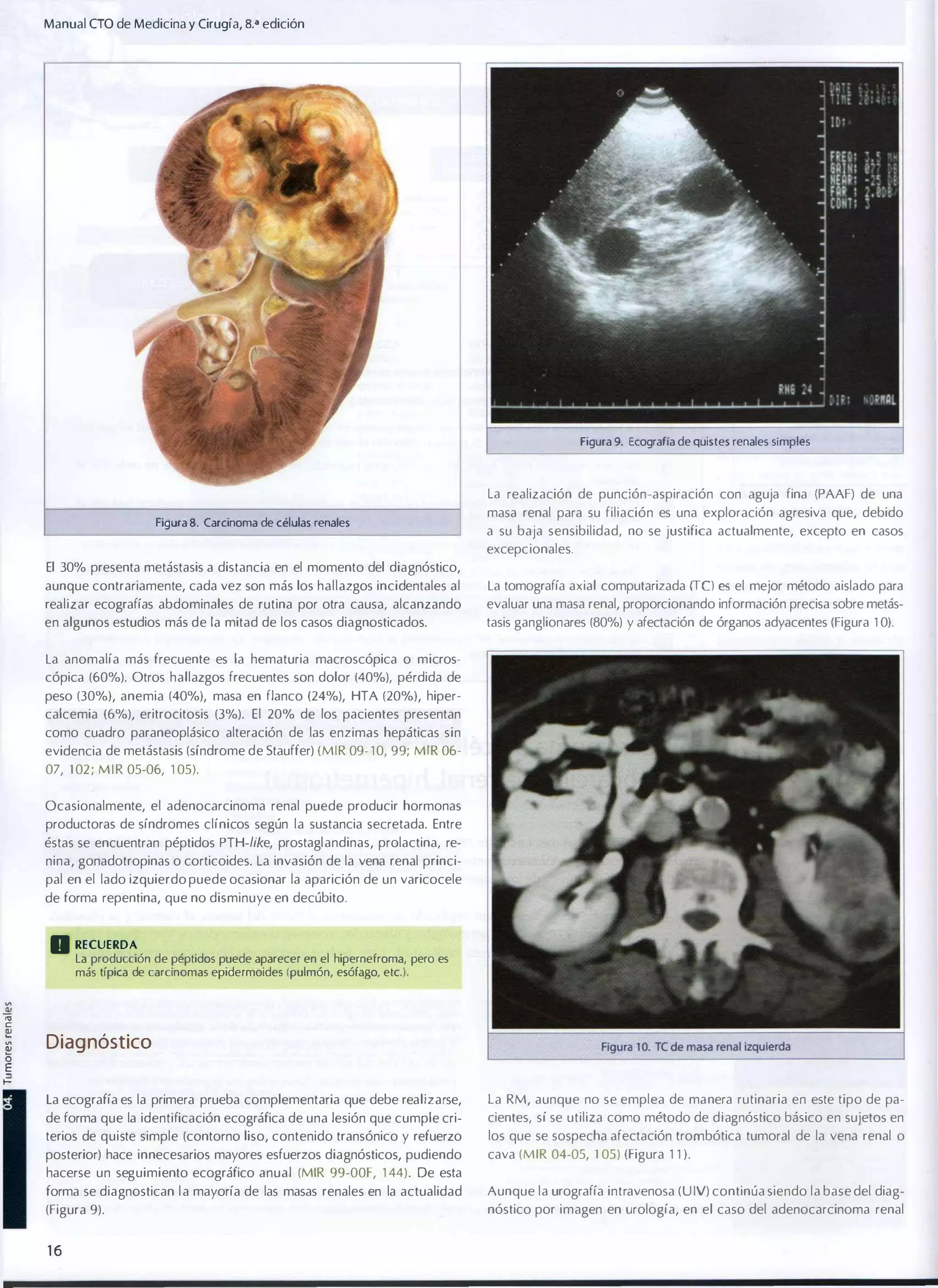 Manual (TO de Medicina y Cirugía, 8.a edición

Figura 9. Ecografía de quistes renales simples

la realización de punción-aspiración con aguja fina (PAAF) de una
Figura 8. Carcinoma de células renales

masa renal para su filiación es una exploración agresiva que, debido
a su baja sensibilidad, no se justifica actualmente, excepto en casos
excepcionales.

El 30% presenta metástasis a distancia en el momento del diagnóstico,
realizar ecografías abdominales de rutina por otra causa, alcanzando

la tomografía axial computarizada (fe) es el mejor método aislado para
evaluar una masa renal, proporcionando información precisa sobre metás­

en algunos estudios más de la mitad de los casos diagnosticados.

tasis ganglionares (80%) y afectación de órganos adyacentes (Figura 1 0).

aunque contrariamente, cada vez son más los hallazgos incidentales al

la anomalía más frecuente es la hematuria macroscópica o micros­
cópica (60%). Otros hallazgos frecuentes son dolor (40%), pérdida de
peso (30%), anemia (40%), masa en flanco (24%), HTA (20%), hiper­
calcemia (6%), eritrocitosis (3%). El 20% de los pacientes presentan
como cuadro paraneoplásico alteración de las enzimas hepáticas sin
evidencia de metástasis (síndrome de Stauffer) (MIR 09- 1 0, 99; MIR 0607, 1 02 ; M I R 05-06, 1 05).
Ocasionalmente, el adenocarcinoma renal puede producir hormonas
productoras de síndromes clínicos según la sustancia secretada. Entre
éstas se encuentran péptidos PTH-like, prostaglandinas, prolactina, re­
nina, gonadotropinas o corticoides. la invasión de la vena renal princi­
pal en el lado izquierdo puede ocasionar la aparición de un varicocele
de forma repentina, que no disminuye en decúbito.

o RECUERDA

la producción de péptidos puede aparecer en el hipernefroma, pero es
más típica de carcinomas epidermoides (pulmón, esófago, etc.).

"

�

"

�
�
o

Diag nóstico

E

.=
La ecografía es la primera prueba complementaria que debe realizarse,

La RM, aunque no se emplea de manera rutinaria en este tipo de pa­

de forma que la identificación ecográfica de una lesión que cumple cri­
terios de quiste simple (contorno liso, contenido transónico y refuerzo

cientes, sí se utiliza como método de diagnóstico básico en sujetos en

posterior) hace innecesarios mayores esfuerzos diagnósticos, pudiendo
hacerse un seguimiento ecográfico anual (MIR 99-00F, 1 44). De esta

cava (MIR 04-05, 1 05) (Figura 1 1 ).

forma se diagnostican l a mayoría de las masas renales en la actualidad

Aunque la urografía intravenosa (U IV) continúa siendo la base del diag­

(Figura 9).

nóstico por imagen en urología, en el caso del adenocarcinoma renal

16

los que se sospecha afectación lrombótica tumoral de la vena renal o

 