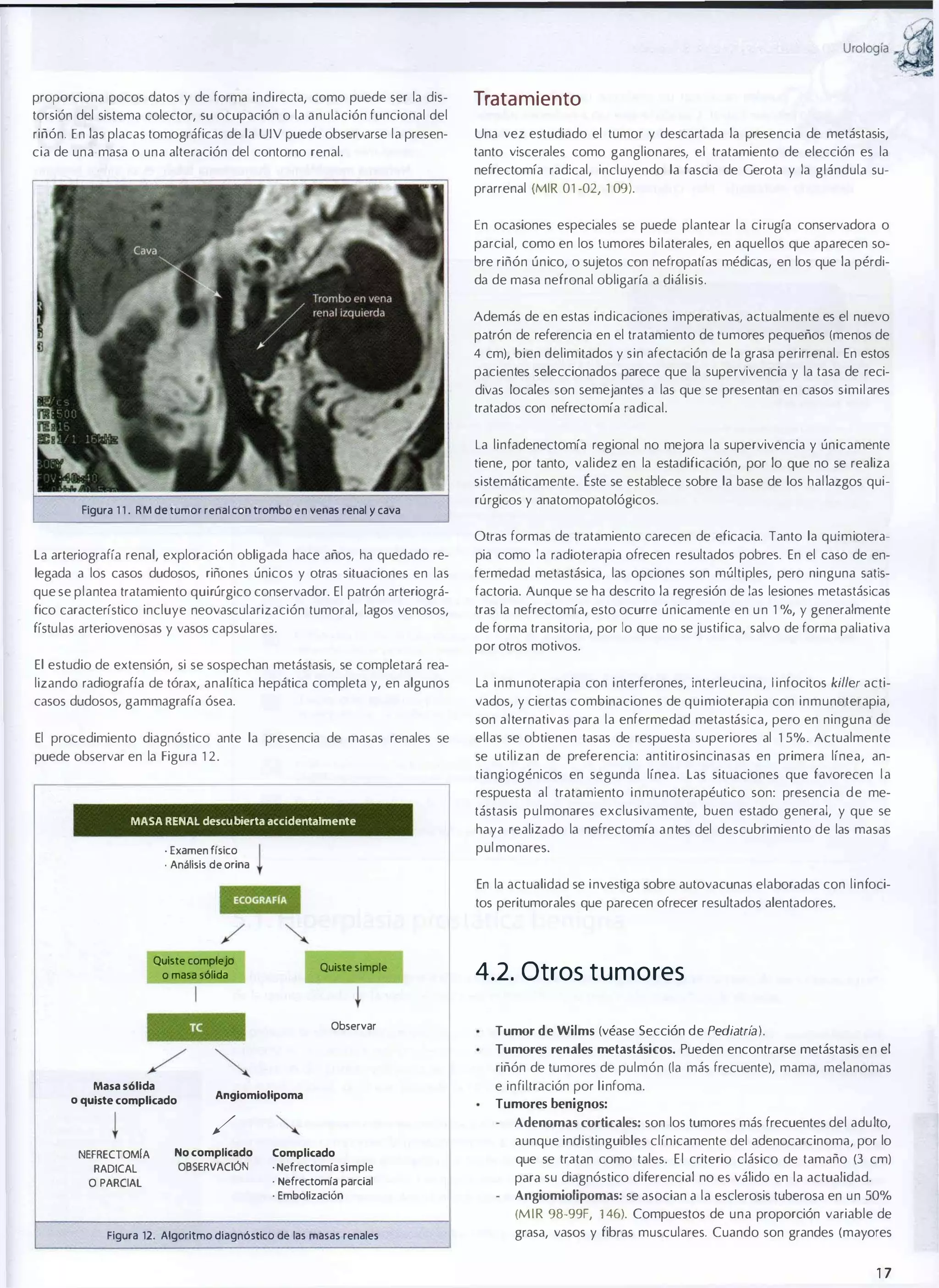 UrOIOgía

proporciona pocos datos y de forma indirecta, como puede ser la dis­
torsión del sistema colector, su ocupación o la anulación funcional del
riñón. En las placas tomográficas de la UIV puede observarse la presen­
cia de una masa o una alteración del contorno renal.

Trata miento
Una vez estudiado el tumor y descartada la presencia de metástasis,
tanto viscerales como ganglionares, el tratamiento de elección es la
nefrectomía radical, incluyendo la fascia de Gerota y la glándula su­
prarrenal (MIR 01 -02, 1 09).
En ocasiones especiales se puede plantear la cirugía conservadora o
parcial, como en los tumores bilaterales, en aquellos que aparecen so­
bre riñón único, o sujetos con nefropatías médicas, en los que la pérdi­
da de masa nefronal obligaría a diálisis.
Además de en estas indicaciones imperativas, actualmente es el nuevo
patrón de referencia en el tratamiento de tumores pequeños (menos de
4 cm), bien delimitados y sin afectación de la grasa perirrenal. En estos
pacientes seleccionados parece que la supervivencia y la tasa de reci­
divas locales son semejantes a las que se presentan en casos similares
tratados con nefrectomía radical.
La linfadenectomía regional no mejora la supervivencia y únicamente
tiene, por tanto, validez en la estadificación, por lo que no se realiza
sistemáticamente. É ste se establece sobre la base de los hallazgos qui­

Figura 1 1 . R M de tumor renal con trombo en venas renal '1 cava

rúrgicos y anatomopatológicos.
Otras formas de tratamiento carecen de eficacia. Tanto la quimiotera­

La arteriografía renal, exploración obligada hace años, ha quedado re­

pia como la radioterapia ofrecen resultados pobres. En el caso de en­

legada a los casos dudosos, riñones únicos y otras situaciones en las

fermedad metastásica, las opciones son múltiples, pero ninguna satis­

que se plantea tratamiento quirúrgico conservador. El patrón arteriográ­

factoria. Aunque se ha descrito la regresión de las lesiones metastásicas

fico característico incluye neovascularización tumoral, lagos venosos,

tras la nefrectomía, esto ocurre únicamente en u n 1 %, Y generalmente

fístulas arteriovenosas y vasos capsulares.

de forma transitoria, por lo que no se justifica, salvo de forma paliativa
por otros motivos.

El estudio de extensión, si se sospechan metástasis, se completará rea­
La inmunoterapia con i nterferones, interleucina, l infocitos killer acti­

lizando radiografía de tórax, analítica hepática completa y, en algunos
casos dudosos, gammagrafía ósea.

vados, y ciertas combinaciones de quimioterapia con inmunoterapia,

El procedimiento diagnóstico ante la presencia de masas renales se

ellas se obtienen tasas de respuesta superiores al 1 5%. Actualmente

puede observar en la Figura 1 2.

se utilizan de preferencia: antitirosincinasas en primera línea, an­

son alternativas para la enfermedad metastásica, pero en ninguna de

tiangiogénicos en segunda línea. Las situaciones que favorecen l a
respuesta al tratamiento i n m unoterapéutico son: presencia d e me­
MASA RENAL descubierta accidentalmente
. Examen físico

. Análisis de orina

I
t

tástasis pulmonares exclusivamente, buen estado general, y que se
haya realizado la nefrectomía a n tes del descubrimiento de las masas
pul monares .
En la actualidad se i nvestiga sobre autovacunas elaboradas con linfoci­
tos peritumorales que parecen ofrecer resultados alentadores.

Quiste complejo

Quiste simple

o masa sólida

Observar

4.2. Otros tumores
Tumor d e Wilms (véase Sección de Pediatrí ) .
a
Tumores renales metastásicos. Pueden encontrarse metástasis en el

riñón de tumores de pulmón (la más frecuente), mama, mela nomas
Masa sólida
o quiste complicado

Angiomiolipoma

/
NEFRECTOMIA

No complicado
OBSERVACiÓN

O PARCIAL

Tumores benignos:
Adenomas corticales: son los tumores más frecuentes del adulto,

Complicado
·

Nefrectomía simple

·

Nefrectomía parcial

·

RADICAL

e infiltración por linfoma.

Embolización

Figura 12. Algoritmo diagnóstico de las masas renales

aunque indistinguibles clínicamente del adenocarcinoma, por lo
que se tratan como tales. E l criterio clásico de tamaño (3 cm)
para su diagnóstico diferencial no es válido en la actualidad.
Angiomiolipomas: se asocian a la esclerosis tuberosa en un 50%
(M I R 98-99F, 146). Compuestos de una proporción variable de
grasa, vasos y fibras musculares. Cuando son grandes (mayores

17

�
�

 