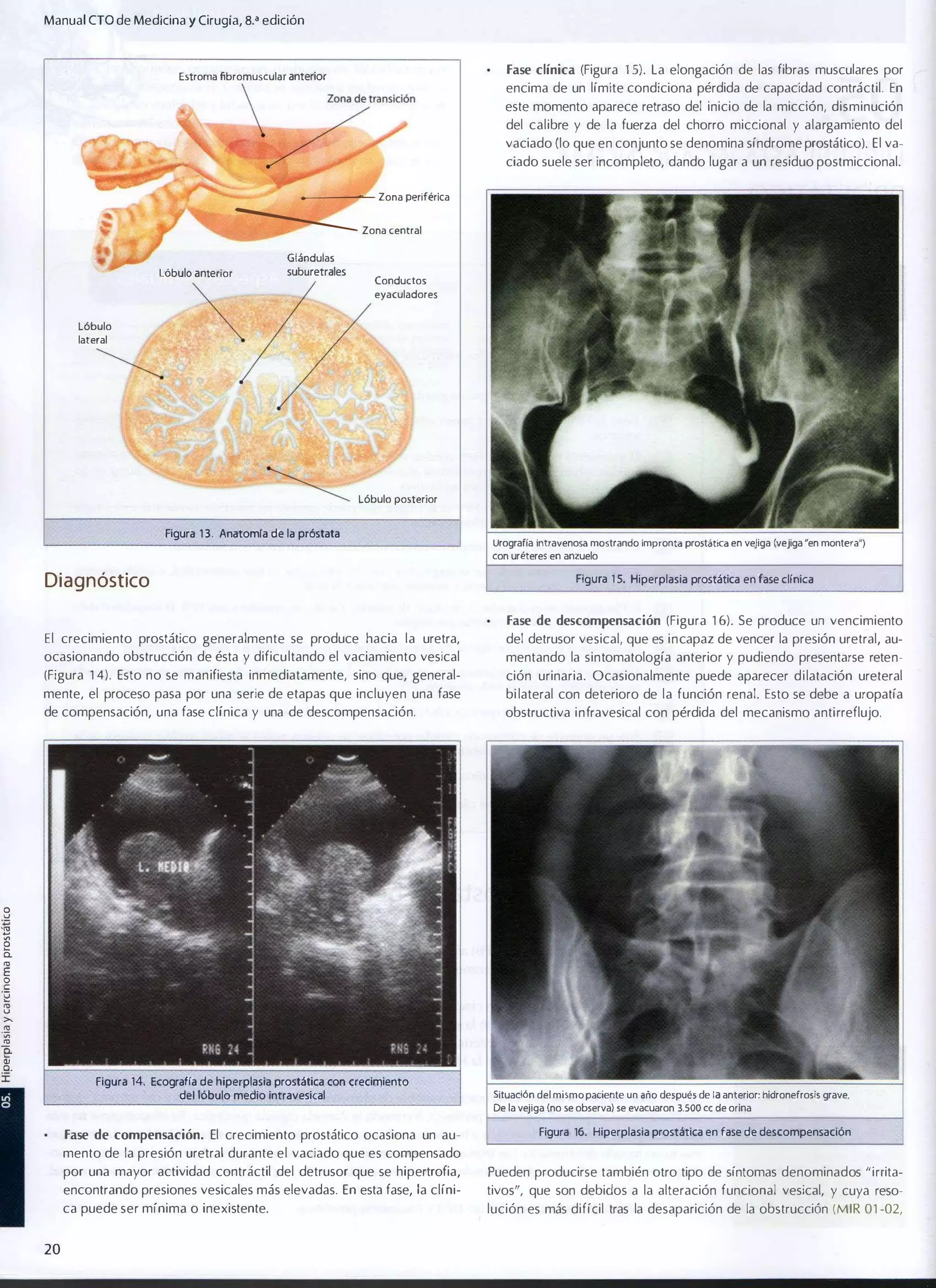 Manual eTO de Medicina y Cirugía, B.a edición
Fase clínica (Figura 1 5). La elongación de las fibras musculares por

Estroma fibromuscular anterior

?7

encima de un límite condiciona pérdida de capacidad contráctil. En
este momento aparece retraso del inicio de la micción, disminución
del calibre y de la fuerza del chorro micdonal y alargamiento del
vaciado (10 que en conjunto se denomina síndrome prostático), El va·
ciado suele ser incompleto, dando lugar a un residuo postmiccional.

�--=,- Zona periférica

�

zona central

Glándulas

Lóbulo anterior

suburetrales

Conductos
eyaculadores

Lóbulo
lateral

Lóbulo posterior

Figura 13 . Anatomra de la próstata

Urografía lntraveno� mostrando Impronta prostática en vejiga (vejiga ·en montera")
con uréteres en anzuelo

Diagnóstico

Figura 1 S. Hiperplasia prostática en fase clínica

Fase de descompensación (Figura 1 6). Se produce un vencimiento

El crecimiento prostático generalmente se produce hacia la uretra,
ocasionando obstrucción de ésta y dificultando el vaciamiento vesical

del detrusor vesical, que es incapaz de vencer la presión uretral, au­

(Figura 1 4). Esto no se manifiesta inmediatamente, sino que, general­

ción urinaria. Ocasionalmente puede aparecer dilatación ureteral

mentando la sintomatología anterior y pudiendo presentarse reten­

mente, el proceso pasa por una serie de etapas que incluyen una fase

bi lateral con deterioro de la función renal. Esto se debe a uropatía

de compensación, una fase clínica y una de descompensación.

obstructiva infravesical con pérdida del mecanismo antirreflujo.

8

"

19

e
"­
•

E
o
e

'2
•

u
>­
.•
,
•

c.
"
"I

Figura 14. Ecografía de hiperplasia prostática con crecimiento
del 16bulo medio intravesical

Fase de compensación. El crecimiento prostático ocasiona un au­

Situación del mismo paciente un año después de la anterior: hidronefrosis grave.

De la vejiga (no se observa) se evacuaron 3500 ce de orina

Figura 16. Hiperplasia prostática en fase de descompensaci6n

mento de la presión uretral durante el vaciado que es compensado
por una mayor actividad contráctil del detrusor que se hipertrofia,

tivos", que son debidos a la alteración funcional vesical, y cuya reso­

ca puede ser mínima o inexistente.

20

Pueden producirse también otro tipo de síntomas denominados "irrita­

encontrando presiones vesicales más elevadas. En esta fase, la clíni­

lución es más difícil tras la desaparición de la obstrucción (MIR 01 -02,

 