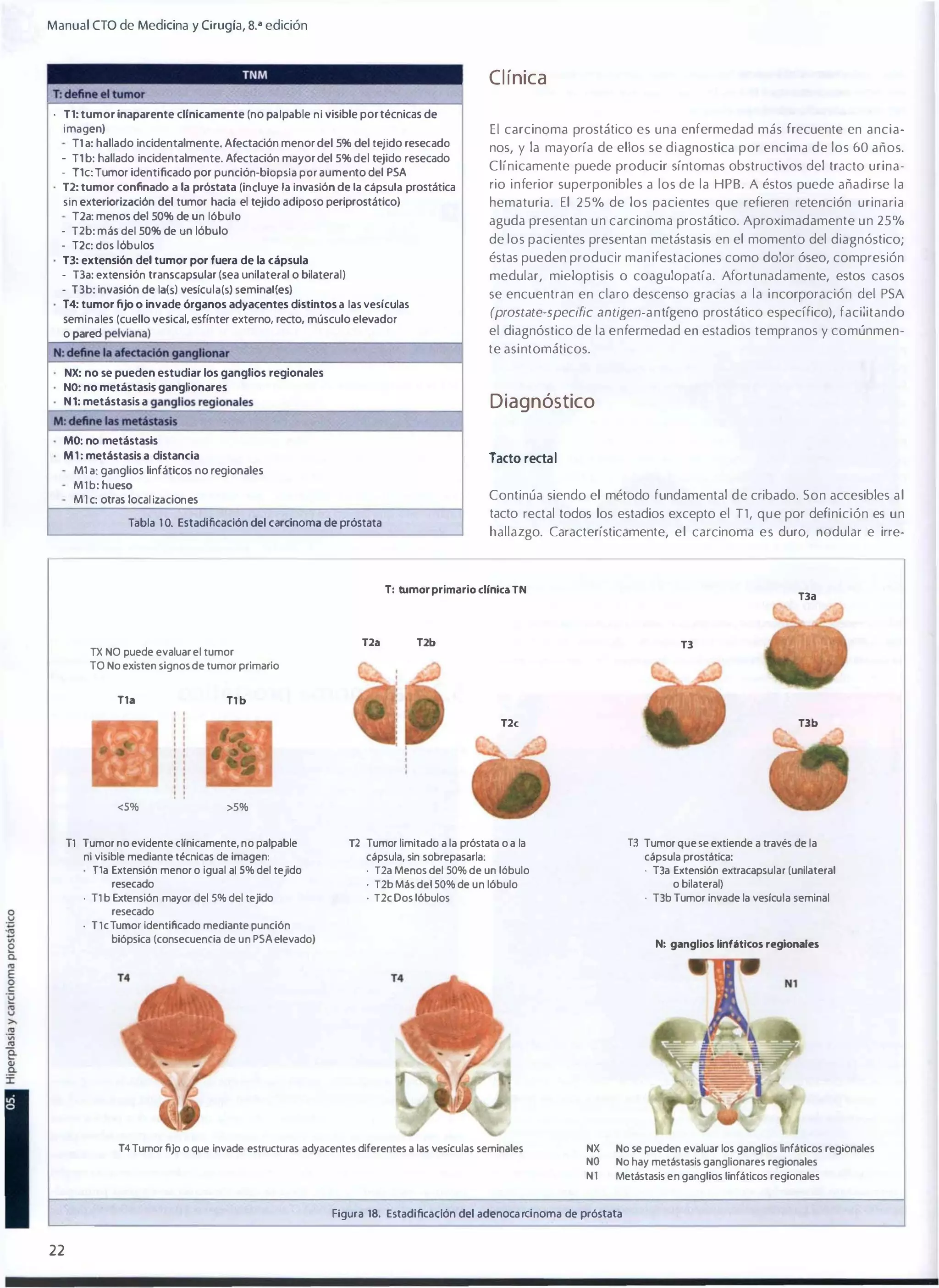Manual eTO de Medicina y Ci rug ía, s.a edición

Cl ínica
. T1: tumor ¡naparente cI(nicamente (no pal pable ni visible por técnicas de
i magen)

T1 a: hallado incidentalmente. Afectación menor del 5% del tej ido resecado
• T l b: hallado incidentalmente. Afectación mayor del 5% del tejido resecado
• Tlc: Tumor identificado por p u nción-biopsia por aumento del PSA
T2: tumor confinado a la próstata (in cl uye la inva sión de la cápsula prostática
sin exteriorización del tumor hacia el tejido adiposo periprostático)
T2a: menos del 50% de u n lóbulo
- T2b: más del 50% de un lóbulo
- T2c: dos l óbulos
T3: extensión del tumor por fuera de la cápsula
- T3a: extensión transcapsular (sea unilateral o bilateral)

El carcinoma prostático es una enfermedad más frecuente en ancia­
nos, y la mayoría de ellos se diagnostica por encima de los 60 años.
Clínicamente puede producir síntomas obstructivos del tracto urina­
rio inferior superponibles a los de la HPB. A éstos puede añadi rse la
hematuria. El 25% de los pacienles que refieren retención urinaria
aguda presentan u n carcinoma prostático. Aproximadamente u n 25%
de los pacientes presentan metástasis en el momento del diagnóstico;
éstas pueden producir man ifestaciones como dolor óseo, compresión
medular, mieloptisis o coagulopatía. Afortunadamente, estos casos

- T3b: invasión de la(s) veslc u l a (s) seminal{es)

se encuentran en claro descenso gracias a la i ncorporación del PSA

T4: tumor fijo o invade órganos adyacentes distintos a las vesículas
sem inales (cuello vesical, esfínter externo, recto, músculo elevador
o pared

(prostate-specific a n tigen -a n tígen o prostático específico), facilitando

el diagnóstico de la enfermedad en estadios tempranos y comúnmen­
te asintomáticos.

NX: no se pueden estudiar los ganglios regionales

NO: no metástasis ganglionares
N 1: metástasis a

Diagnóstico

MO: no metástasis
M l : metástasis a distancia
Ml a: ganglios linfáticos no regionales
Mlb: h ueso
M 1 c: otras local izacion es

Tacto rectal

Continúa siendo el método fundamental de cribado. Son accesibles al
tacto rectal todos los estadios excepto el T1, que por definición es un

Tabla 1 0. Estadificación del carcinoma de próstata

hallazgo. Característicamente, el carcinoma es duro, nodular e irre·

T: tumor primario cUnlca TN

TX NO puede evaluar el tumor
TO No existen signos de tumor primario

na

Tla

na

Tlb

n

nb
Tlc

<5%

nb

>5%

T1 Tumor no evidente dlnic.amente, no palpable
ni visible mediante técnicas de imagen:
na Extensión menor o igual a1 5% del tejido
resecado
. Tl b Extensión mayor del 5% del tejido
resecado
. TlcTumor identificado mediante punción
biópsica (consecuenc.ia de un PSA elevado)

T3 Tumor que se extiende a través de la

T2 Tumor limitado a la próstata o a la
capsula, sin sobrepasarla:
· T2a Menos del 50% de un lóbulo
·
·

capsula prostática:
. TIa Extensión extracapsular (unilateral
o bilateral)
. TIb Tumor invade la veslcula seminal

T2b Más del 50% de un lóbulo
T2c Dos lóbulos

N: ganglios linfáticos regionales

T4 Tumor fijo o que invade estructuras adyacentes diferentes a las veslculas seminales

NX
NO

No se pueden evaluar los ganglios linfáticos regionales
No hay metástasis ganglionares regionales

Nl

Metástasis en ganglios linfáticos regionales

Figura 18. Estadificación del adenoca rd noma de próstata

22

 