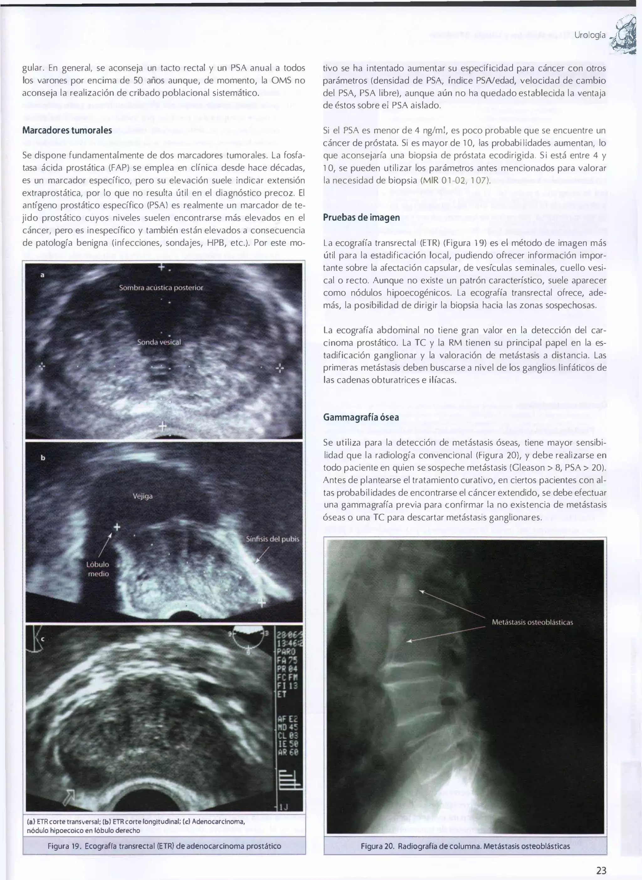 Ur0109¡a

guiar. En general, se aconseja un tacto rectal y un PSA anual a todos

tivo se ha i ntentado aumentar su especificidad para cáncer con otros

los varones por encima de 50 años aunque, de momento, la OMS no

parámetros (densidad de PSA, índice PSNedad, velocidad de cambio

aconseja la realización de cribado poblacional sistemático.

del PSA, PSA libre), aunque aún no ha quedado establecida la ventaja
de éstos sobre el PSA aislado.

Marcadores tumorales

Si el PSA es menor de 4 ng/ml, es poco probable que se encuentre un

Se dispone fundamentalmente de dos marcadores tumorales. La fosfa�

cáncer de próstata. Si es mayor de 1 0, las probabi lidades aumentan, lo
que aconsejaría una biopsia de próstata ecodirigida. S i está entre 4 y

tasa ácida prostática (FAP) se emplea en clínica desde hace décadas,
es un marcador específico, pero su elevación suele indicar extensión

1 0, se pueden utilizar los parámetros antes mencionados para valorar
la necesidad de biopsia (MIR 0 1 -02, 1 07).

extraprostática, por lo que no resulta útil en el diagnóstico precoz. El
antígeno prostático específico (PSA) es realmente un marcador de te�
jido prostático cuyos niveles suelen encontrarse más elevados en el

Pruebas de imagen

cáncer, pero es inespecífico y también están elevados a consecuencia
de patología benigna (infecciones, sondajes, HPB, etc.). Por este mo�

La ecograría transrectal (ETR) (Figura 1 9) es el método de imagen más
útil para la esladificación local, pudiendo ofrecer información impor­
tante sobre la afectación capsular, de vesículas seminales, cuello vesi­
cal o recto. Aunque no existe un patrón característico, suele aparecer
como nódulos hipoecogénicos. La ecografía transrectal ofrece, ade­
más, la posibilidad de dirigir la biopsia hacia las zonas sospechosas.
La ecografía abdominal no tiene gran valor en la detección del car­
cinoma prostático. La TC y la RM tienen su principal papel en la es­
tadificación ganglionar y la valoración de metástasis a distancia. Las
primeras metástasis deben buscarse a nivel de los ganglios l infáticos de
las cadenas obturatrices e ilíacas.

Gammagrafía ósea

Se utiliza para la detección de metástasis óseas, tiene mayor sensibi­
lidad que la radiología convencional (Figura 20), y debe realizarse en
todo paciente en quien se sospeche metástasis (Gleason > 8, PSA > 20).
Antes de plantearse el tratamiento curativo, en ciertos pacientes con al­
tas probabil idades de encontrarse el cáncer extendido, se debe efectuar
una gammagrafía previa para confirmar la no existencia de metástasis
óseas o una TC para descartar metástasis ganglionares.

¡I) ETR corte transversal; {b} ETR corte longitudinal; (el Adenocarclnoma,
nódulo hlpoecojco en lóbulo derecho

Figura 19. Ecografra transrectal (ETR) de adenocarcinoma prostático

Figura 20. Radiografía de columna. Metástasis osteoblásticas

23

.a

 