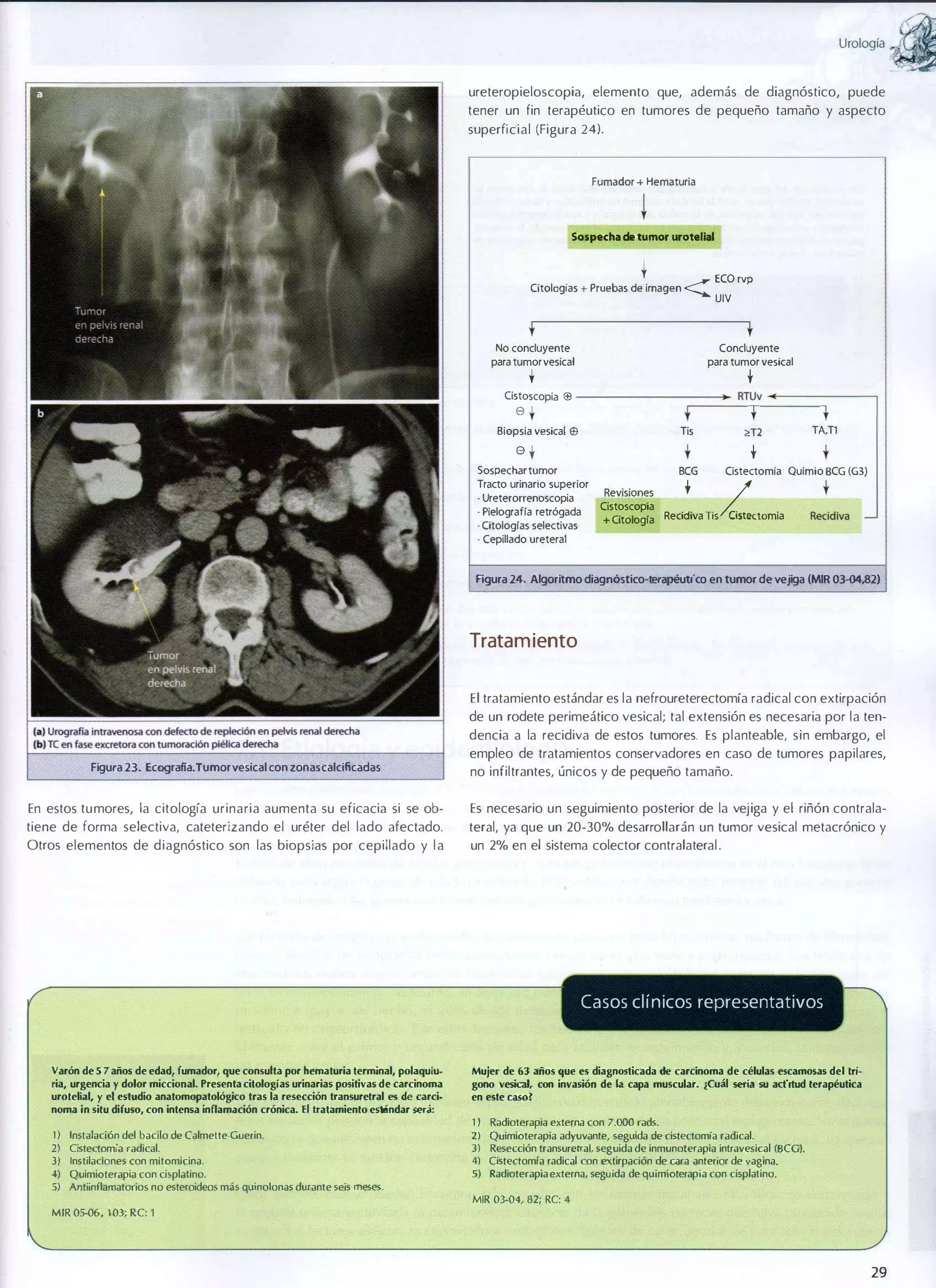 UrOIOgía

ureteropieloscopia, elemento que, además de diagnóstico, puede
tener un fin terapéutico en tumores de pequeño tamaño y aspecto
superficial (Figura 241.

Fumador + Hematuria

Sospecha d. tumor uroteUal

+

Citologias + Pruebas de imagen

<: ECO 'VP
UIV

t

t

No concluyente

Concluyente

para tumor vesical

para tumor vesical

t

-;:

t
:....' �
��
t

:::; - l
�-

Cistoscopia ES - - - - - - - = � RTUV
=
.
'-= =
'::: =

6t

t

Biopsia vesical ES ----Tis
--�.�

6t

Sospechar tumor

·

Ureterorrenoscopia

·

Pielografía retrógada

·

Citologías selectivas

·

Revisiones

Cepillado ureteral

Cistoscopia
+ Citología

ReCi iva TíS

t

TA,Tl

t

� ¿

BCG

Tracto urinario superior

2:12

�

Cistectomfa Quimio BCG (G3)

ClOmia

R

diva

_

Ftgura 24. Algoritmo diagoóstico-terapéutko en tumor de vejiga (MIR 03-04,82)

Tratam iento
El tratamiento estándar es la nefroureterectomía radical con extirpación
de un rodete perimeático vesical; tal extensión es necesaria por la ten­
dencia a la recidiva de estos tumores. Es planteable, sin embargo, el
Figura 23. Ecografia.Tumor vesical con zonas calcificadas

empleo de tratamientos conservadores en caso de tumores papilares,
no infiltrantes, únicos y de pequeño tamaño.

En estos tumores, la citología urinaria aumenta su eficacia si se ob­

Es necesario un seguimiento posterior de la vejiga y el riñón contra la­

tiene de forma selectiva, cateterizando el uréter del lado afectado.

teral, ya que un 20-30% desarrollarán un tumor vesical metacrónico y

Otros elementos de diagnóstico son las biopsias por cepillado y l a

un 2% en el sistema colector contralateral .

Casos clínicos representativos

Varón de 5 7 años de edad, fumador, que consulta por hematuria terminal, polaquiu­
ria, urgencia y dolor miccional. Presenta citologías urinarias positivas de carcinoma
urotelial, y el estudio anatomopatológico tras la resección transurelral es de carci·
noma in silu difuso, con intensa inflamación crónica. El tratamiento estándar será:

Mujer de 63 años que es diagnosticada de carcinoma de células escamosas del Irí­
gono vesical, con invasión de la capa muscular. ¡Cuál seria su actitud lerapéutica
en este caso?

1 ) Instalación del bacilo de Calmette-Guerin.
2) Cistectomía radical.

2)

3)

Instilaciones con mitomicina.

4) Quimioterapia con cisplalino.

5) Antiinllamatorios no esteroideos más quinolonas durante seis meses.

MIR 05-06, 1 03; RC: 1

1)

Radioterapia externa con 7.000 rads.

Quimioterapia adyuvante, seguida de cistectomía radical.
3) Resección transuretral, seguida de inmunolerapia intravesical (BCG).
4) Cistectomía radical con extirpación de cara anterior de vagina.
5) Radioterapia externa, seguida de quimioterapia con cisplatino.
MIR 03-04, 82; RC: 4

29

�

 