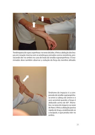 Tendinopatia do supra-espinhoso: no teste de Jobe, é feita a abdução dos bra-
ços em rotação interna com os antebraços estirados contra resistência, pro-
vocando dor no ombro no caso de lesão do tendão supraespinhoso. O exa-
minador deve também observar a redução da força do membro afetado.




                                           Síndrome do impacto: é a com-
                                           pressão do tendão supraespinho-
                                           so entre a cabeça do úmero e o
                                           arco acromial quando o braço é
                                           abduzido acima de 60º. Mano-
                                           bra: no teste do impacto ou teste
                                           de Neer, é feita a abdução passiva
                                           rápida do braço, estabilizando-se
                                           a escápula, o que produz dor no
                                           ombro.



                                                                                31
 
