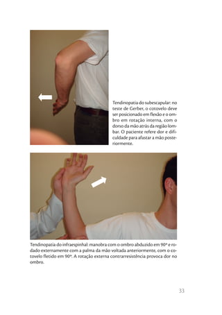 Tendinopatia do subescapular: no
                                         teste de Gerber, o cotovelo deve
                                         ser posicionado em flexão e o om-
                                         bro em rotação interna, com o
                                         dorso da mão atrás da região lom-
                                         bar. O paciente refere dor e difi-
                                         culdade para afastar a mão poste-
                                         riormente.




Tendinopatia do infraespinhal: manobra com o ombro abduzido em 90º e ro-
dado externamente com a palma da mão voltada anteriormente, com o co-
tovelo fletido em 90º. A rotação externa contrarresistência provoca dor no
ombro.




                                                                              33
 
