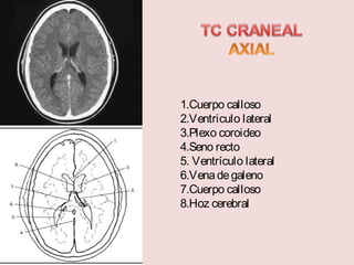 1.Cuerpo calloso 
2.Ventriculo lateral 
3.Plexo coroideo 
4.Seno recto 
5. Ventrículo lateral 
6.Vena de galeno 
7.Cuerpo calloso 
8.Hoz cerebral 
 