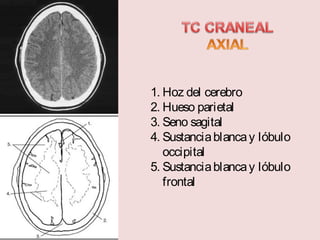 1. Hoz del cerebro 
2. Hueso parietal 
3. Seno sagital 
4. Sustancia blanca y lóbulo 
occipital 
5. Sustancia blanca y lóbulo 
frontal 
 
