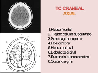 1.Hueso frontal 
2. Tejido celular subcutáneo 
3.Seno sagital superior 
4.Hoz cerebral 
5.Hueso parietal 
6.Lobulo occipital 
7.Sustancia blanca cerebral 
8.Sustancia gris 
 