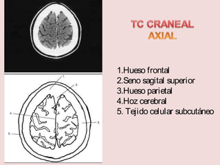 1.Hueso frontal 
2.Seno sagital superior 
3.Hueso parietal 
4.Hoz cerebral 
5. Tejido celular subcutáneo 
 