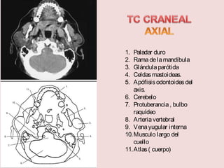 1. Paladar duro 
2. Rama de la mandíbula 
3. Glándula parótida 
4. Celdas mastoideas. 
5. Apófisis odontoides del 
axis. 
6. Cerebelo 
7. Protuberancia , bulbo 
raquídeo 
8. Arteria vertebral 
9. Vena yugular interna 
10.Musculo largo del 
cuello 
11.Atlas ( cuerpo) 
 