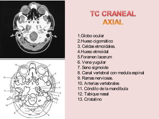 1.Globo ocular 
2.Hueso cigomático 
3. Celdas etmoidales. 
4.Hueso etmoidal 
5.Foramen lacerum 
6. Vena yugular 
7. Seno sigmoide 
8. Canal vertebral con medula espinal 
9. Ramas nerviosas. 
10. Arterias vertebrales 
11. Cóndilo de la mandíbula 
12. Tabique nasal 
13. Cristalino 
 