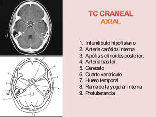 1. Infundíbulo hipofisiario 
2. Arteria carótida interna 
3. Apófisis clinoides posterior. 
4. Arteria basilar. 
5. Cerebelo 
6. Cuarto ventrículo 
7. Hueso temporal 
8. Rama de la yugular interna 
9. Protuberancia 
 