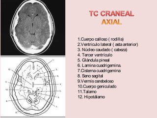 1.Cuerpo calloso ( rodilla) 
2.Ventriculo lateral ( asta anterior) 
3. Núcleo caudado ( cabeza) 
4. Tercer ventrículo 
5. Glándula pineal 
6. Lamina cuadrigemina. 
7.Cisterna cuadrigemina 
8. Seno sagital 
9.Vermis cerebeloso 
10.Cuerpo geniculado 
11.Talamo 
12. Hipotálamo 
 