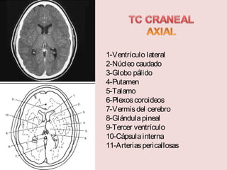 1-Ventrículo lateral 
2-Núcleo caudado 
3-Globo pálido 
4-Putamen 
5-Talamo 
6-Plexos coroideos 
7-Vermis del cerebro 
8-Glándula pineal 
9-Tercer ventrículo 
10-Cápsula interna 
11-Arterias pericallosas 
 