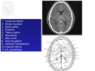 1. Ventrículo lateral 
2. Núcleo caudado 
3. Globu pálido 
4. Putamen 
5. Tálamo óptico 
6. Hipocampo 
7. Seno recto 
8. Vena de galeno 
9. Adhesión intratalamico 
10.Capsula interna 
11.Art. pericaliosas 
1. Ventrículo lateral 
2. Núcleo caudado 
3. Globu pálido 
4. Putamen 
5. Tálamo óptico 
6. Hipocampo 
7. Seno recto 
8. Vena de galeno 
9. Adhesión intratalamico 
10.Capsula interna 
11.Art. pericaliosas 
 