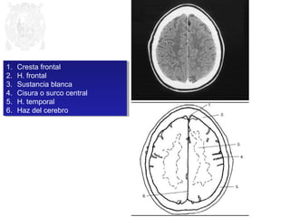 1. Cresta frontal 
2. H. frontal 
3. Sustancia blanca 
4. Cisura o surco central 
5. H. temporal 
6. Haz del cerebro 
1. Cresta frontal 
2. H. frontal 
3. Sustancia blanca 
4. Cisura o surco central 
5. H. temporal 
6. Haz del cerebro 
 