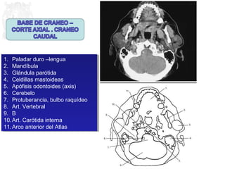 1. Paladar duro –lengua 
2. Mandíbula 
3. Glándula parótida 
4. Celdillas mastoideas 
5. Apófisis odontoides (axis) 
6. Cerebelo 
7. Protuberancia, bulbo raquídeo 
8. Art. Vertebral 
9. B 
10.Art. Carótida interna 
11.Arco anterior del Atlas 
1. Paladar duro –lengua 
2. Mandíbula 
3. Glándula parótida 
4. Celdillas mastoideas 
5. Apófisis odontoides (axis) 
6. Cerebelo 
7. Protuberancia, bulbo raquídeo 
8. Art. Vertebral 
9. B 
10.Art. Carótida interna 
11.Arco anterior del Atlas 
 