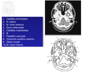 1. Celdillas etmoidales 
2. N. óptico 
3. M. recto externo 
4. Seno esfenoidal 
5. Celdillas mastoideas 
6. B 
7. Pabellón auricular 
8. Conducto auditivo externo 
9. Globo ocular 
10.M. recto interno 
1. Celdillas etmoidales 
2. N. óptico 
3. M. recto externo 
4. Seno esfenoidal 
5. Celdillas mastoideas 
6. B 
7. Pabellón auricular 
8. Conducto auditivo externo 
9. Globo ocular 
10.M. recto interno 
 