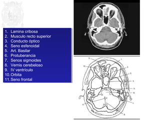 1. Lamina cribosa 
2. Musculo recto superior 
3. Conducto óptico 
4. Seno esfenoidal 
5. Art. Basilar 
6. Protuberancia 
7. Senos sigmoides 
8. Vernis cerebeloso 
9. IV ventrículo 
10.Orbita 
11.Seno frontal 
1. Lamina cribosa 
2. Musculo recto superior 
3. Conducto óptico 
4. Seno esfenoidal 
5. Art. Basilar 
6. Protuberancia 
7. Senos sigmoides 
8. Vernis cerebeloso 
9. IV ventrículo 
10.Orbita 
11.Seno frontal 
 