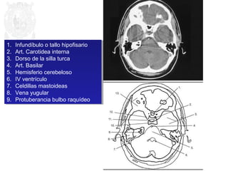 1. Infundíbulo o tallo hipofisario 
2. Art. Carotidea interna 
3. Dorso de la silla turca 
4. Art. Basilar 
5. Hemisferio cerebeloso 
6. IV ventrículo 
7. Celdillas mastoideas 
8. Vena yugular 
9. Protuberancia bulbo raquídeo 
1. Infundíbulo o tallo hipofisario 
2. Art. Carotidea interna 
3. Dorso de la silla turca 
4. Art. Basilar 
5. Hemisferio cerebeloso 
6. IV ventrículo 
7. Celdillas mastoideas 
8. Vena yugular 
9. Protuberancia bulbo raquídeo 
 