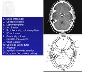 1. Seno esfenoidal 
2. Conducto óptico 
3. Lóbulo temporal 
4. Art. Basilar 
5. Protuberancia, bulbo raquídeo 
6. IV ventrículo 
7. Senos sigmoideo 
8. Celdillas mastoideas 
9. Vena yugular 
10.Dorso de la silla turca 
11.Hipófisis 
12.Apófisis crinoides anterior 
13.H. frontal (techo de la orbita) 
1. Seno esfenoidal 
2. Conducto óptico 
3. Lóbulo temporal 
4. Art. Basilar 
5. Protuberancia, bulbo raquídeo 
6. IV ventrículo 
7. Senos sigmoideo 
8. Celdillas mastoideas 
9. Vena yugular 
10.Dorso de la silla turca 
11.Hipófisis 
12.Apófisis crinoides anterior 
13.H. frontal (techo de la orbita) 
 