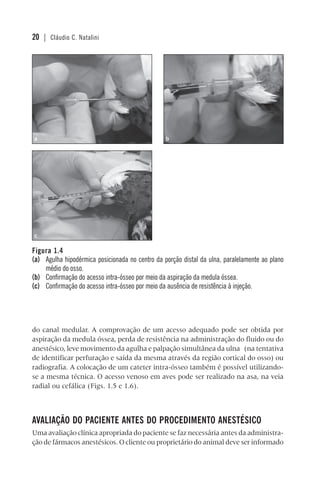 20 | Cláudio C. Natalini
do canal medular. A comprovação de um acesso adequado pode ser obtida por
aspiração da medula óssea, perda de resistência na administração do fluido ou do
anestésico, leve movimento da agulha e palpação simultânea da ulna (na tentativa
de identificar perfuração e saída da mesma através da região cortical do osso) ou
radiografia. A colocação de um cateter intra-ósseo também é possível utilizando-
se a mesma técnica. O acesso venoso em aves pode ser realizado na asa, na veia
radial ou cefálica (Figs. 1.5 e 1.6).
AVALIAÇÃO DO PACIENTE ANTES DO PROCEDIMENTO ANESTÉSICO
Uma avaliação clínica apropriada do paciente se faz necessária antes da administra-
ção de fármacos anestésicos. O cliente ou proprietário do animal deve ser informado
Figura 1.4
(a) Agulha hipodérmica posicionada no centro da porção distal da ulna, paralelamente ao plano
médio do osso.
(b) Confirmação do acesso intra-ósseo por meio da aspiração da medula óssea.
(c) Confirmação do acesso intra-ósseo por meio da ausência de resistência à injeção.
ba
c
 
