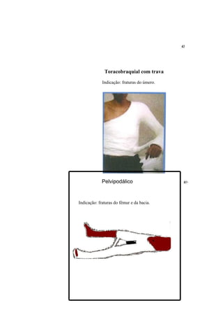 Toracobraquial com trava

             Indicação: fraturas do úmero.




             Pelvipodálico


Indicação: fraturas do fêmur e da bacia.
 