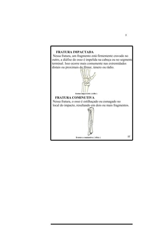 FRATURA IMPACTADA
 Nessa fratura, um fragmento está firmemente cravado no
outro, a diáfise do osso é impelida na cabeça ou no segmento
terminal. Isso ocorre mais comumente nas extremidades
distais ou proximais do fêmur, úmero ou rádio.




  FRATURA COMINUTIVA
Nessa fratura, o osso é estilhaçado ou esmagado no
local do impacto, resultando em dois ou mais fragmentos.
 