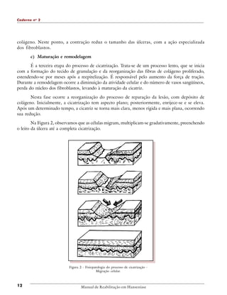Caderno n o 2

colágeno. Neste ponto, a contração reduz o tamanho das úlceras, com a ação especializada
dos fibroblastos.
c) Maturação e remodelagem
É a terceira etapa do processo de cicatrização. Trata-se de um processo lento, que se inicia
com a formação do tecido de granulação e da reorganização das fibras de colágeno proliferado,
estendendo-se por meses após a reepitelização. É responsável pelo aumento da força de tração.
Durante a remodelagem ocorre a diminuição da atividade celular e do número de vasos sangüíneos,
perda do núcleo dos fibroblastos, levando à maturação da cicatriz.
Nesta fase ocorre a reorganização do processo de reparação da lesão, com depósito de
colágeno. Inicialmente, a cicatrização tem aspecto plano; posteriormente, enrijece-se e se eleva.
Após um determinado tempo, a cicatriz se torna mais clara, menos rígida e mais plana, ocorrendo
sua redução.
Na Figura 2, observamos que as células migram, multiplicam-se gradativamente, preenchendo
o leito da úlcera até a completa cicatrização.

Figura 2 - Fisiopatologia do processo de cicatrização Migração celular.

12

Manual de Reabilitação em Hanseníase

 