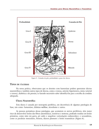 Condutas para Úlceras Neurotróficas e Traumáticas

Profundidade

Camadas da Pele

Grau I

Epiderme

Grau II

Derme

Grau III

Subcutâneo

Grau IV

Músculo

Figura 5 - Camadas da pele, profundidade e graus das úlceras.

TIPOS DE

ÚLCERAS

Na nossa prática, observamos que os doentes com hanseníase podem apresentar úlceras
neurotróficas e também outros tipos de úlceras, como a venosa, arterial, hipertensiva, mista (arterial
e venosa), diabética e de pressão, se fazendo necessário saber identificá-las para a escolha da conduta
adequada.

Úlcera Neurotrófica
Esta úlcera é causada por neuropatia periférica, em decorrência de algumas patologias de
base, tais como: hanseníase, diabetes mellitus, alcoolismo e outras.
As pessoas portadoras dessas patologias, que acometem os nervos periféricos, têm maior
risco de desenvolver lesões das fibras autonômicas, sensitivas e motoras, podendo resultar em lesões
primárias, como mão em garra, pé caído e anquilose (articulações endurecidas); e secundárias,
como as paralisias musculares, fissuras, úlceras plantares e lesões traumáticas (Figura 6).

Manual de Reabilitação em Hanseníase

17

 