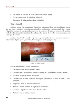 Caderno n o 2

•

Tratamento de eczemas de estase com corticoterapia tópica.

•

Evitar traumatismos de membros inferiores.

•

Tratamento de infecções bacterianas e fúngicas.

Úlcera Arterial
A úlcera arterial é produzida pela desnutrição cutânea devido a uma insuficiência arterial
que tem como resultado a isquemia, caracterizando-se clinicamente por extremidade fria e escura.
Há palidez, ausência de estase, retardo no retorno da cor após a elevação do membro, pele atrófica,
perda de pêlo, diminuição ou ausência das pulsações das artérias do pé e dor severa aumentada com
a elevação das pernas.
A úlcera é de bordas cortadas a pique, irregular, localizada nos tornozelos, maléolos e
extremidades digitais (perna, calcanhar, dorso do pé ou artelho) (Figura 10).

Figura 10 - Úlcera arterial.

A prevenção da úlcera arterial consiste em:

•
•

Proteção contra traumatismos térmicos, mecânicos e químicos no membro afetado.

•

Evitar ou recuperar atrofias musculares.

•

Cuidado com as unhas, evitando paroníquias (inflamação ao redor da unha) e unha
encravada.

•

Pesquisar e tratar as micoses superficiais.

•

Reduzir e manter controle de triglicérides e colesterol.

•

Controlar a hipertensão arterial e o diabetes mellitus.

•
22

Elevação da cabeceira da cama em 20cm.

Reduzir o uso de cafeína e tabaco.

Manual de Reabilitação em Hanseníase

 