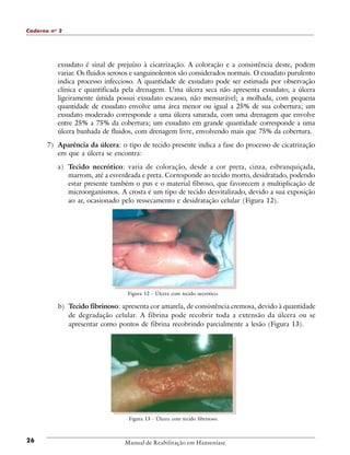 Caderno n o 2

exsudato é sinal de prejuízo à cicatrização. A coloração e a consistência deste, podem
variar. Os fluidos serosos e sanguinolentos são considerados normais. O exsudato purulento
indica processo infeccioso. A quantidade de exsudato pode ser estimada por observação
clínica e quantificada pela drenagem. Uma úlcera seca não apresenta exsudato; a úlcera
ligeiramente úmida possui exsudato escasso, não mensurável; a molhada, com pequena
quantidade de exsudato envolve uma área menor ou igual a 25% de sua cobertura; um
exsudato moderado corresponde a uma úlcera saturada, com uma drenagem que envolve
entre 25% a 75% da cobertura; um exsudato em grande quantidade corresponde a uma
úlcera banhada de fluidos, com drenagem livre, envolvendo mais que 75% da cobertura.
7) Aparência da úlcera: o tipo de tecido presente indica a fase do processo de cicatrização
em que a úlcera se encontra:
a) Tecido necrótico: varia de coloração, desde a cor preta, cinza, esbranquiçada,
marrom, até a esverdeada e preta. Corresponde ao tecido morto, desidratado, podendo
estar presente também o pus e o material fibroso, que favorecem a multiplicação de
microorganismos. A crosta é um tipo de tecido desvitalizado, devido a sua exposição
ao ar, ocasionado pelo ressecamento e desidratação celular (Figura 12).

Figura 12 - Úlcera com tecido necrótico.

b) Tecido fibrinoso: apresenta cor amarela, de consistência cremosa, devido à quantidade
de degradação celular. A fibrina pode recobrir toda a extensão da úlcera ou se
apresentar como pontos de fibrina recobrindo parcialmente a lesão (Figura 13).

Figura 13 - Úlcera com tecido fibrinoso.

26

Manual de Reabilitação em Hanseníase

 