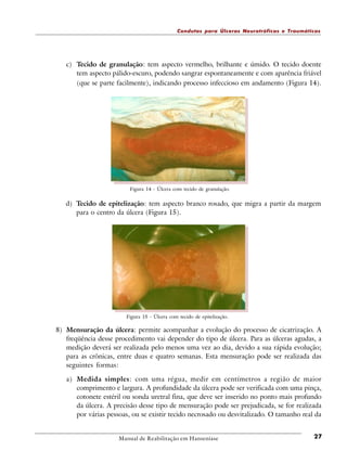 Condutas para Úlceras Neurotróficas e Traumáticas

c) Tecido de granulação: tem aspecto vermelho, brilhante e úmido. O tecido doente
tem aspecto pálido-escuro, podendo sangrar espontaneamente e com aparência friável
(que se parte facilmente), indicando processo infeccioso em andamento (Figura 14).

Figura 14 - Úlcera com tecido de granulação.

d) Tecido de epitelização: tem aspecto branco rosado, que migra a partir da margem
para o centro da úlcera (Figura 15).

Figura 15 - Úlcera com tecido de epitelização.

8) Mensuração da úlcera: permite acompanhar a evolução do processo de cicatrização. A
freqüência desse procedimento vai depender do tipo de úlcera. Para as úlceras agudas, a
medição deverá ser realizada pelo menos uma vez ao dia, devido a sua rápida evolução;
para as crônicas, entre duas e quatro semanas. Esta mensuração pode ser realizada das
seguintes formas:
a) Medida simples: com uma régua, medir em centímetros a região de maior
comprimento e largura. A profundidade da úlcera pode ser verificada com uma pinça,
cotonete estéril ou sonda uretral fina, que deve ser inserido no ponto mais profundo
da úlcera. A precisão desse tipo de mensuração pode ser prejudicada, se for realizada
por várias pessoas, ou se existir tecido necrosado ou desvitalizado. O tamanho real da

Manual de Reabilitação em Hanseníase

27

 