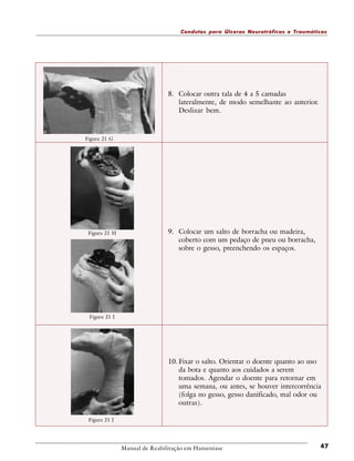 Condutas para Úlceras Neurotróficas e Traumáticas

8. Colocar outra tala de 4 a 5 camadas
lateralmente, de modo semelhante ao anterior.
Deslizar bem.

Figura 21 G

Figura 21 H

9. Colocar um salto de borracha ou madeira,
coberto com um pedaço de pneu ou borracha,
sobre o gesso, preenchendo os espaços.

Figura 21 I

10. Fixar o salto. Orientar o doente quanto ao uso
da bota e quanto aos cuidados a serem
tomados. Agendar o doente para retornar em
uma semana, ou antes, se houver intercorrência
(folga no gesso, gesso danificado, mal odor ou
outras).
Figura 21 J

Manual de Reabilitação em Hanseníase

47

 