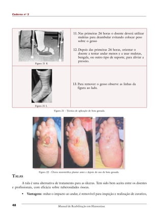 Caderno n o 2

11. Nas primeiras 24 horas o doente deverá utilizar
muletas para deambular evitando colocar peso
sobre o gesso

Figura 21 K

12. Depois das primeiras 24 horas, orientar o
doente a tentar andar menos e a usar muletas,
bengala, ou outro tipo de suporte, para aliviar a
pressão.

13. Para remover o gesso observe as linhas da
figura ao lado.

Figura 21 L
Figura 21 - Técnica de aplicação de bota gessada.

Figura 22 - Úlcera neurotrófica plantar antes e depois do uso da bota gessada.

TALAS
A tala é uma alternativa de tratamento para as úlceras. Tem sido bem aceita entre os doentes
e profissionais, com eficácia sobre tuberosidades ósseas.

•
48

Vantagens: reduz o impacto ao andar, é removível para inspeção e realização de curativo,

Manual de Reabilitação em Hanseníase

 