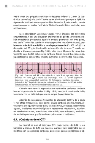 M a n u a l d e e l e c t r o c a r d i o g r a f í a p a r a e n f e r m e r í a
66
Pág. 64 ©Antonio Peña Rodríguez
Fig. 16.6. Descenso del ST o inversión de la onda T de tipo específico: 1)
Bloqueo de rama (QRS ancho con morfología rSR’) 2) Efecto digitálico
(descenso con concavidad superior) 3) Sobrecarga cardiaca (invertida y
asimétrica) 4) T isquémica (invertida y simétrica) 5) Descenso de ST por lesión
subendocárdica. 6). Hipopotasemia (presencia de onda U).
PR) o tener una pequeña elevación o descenso inferior a 2 mm (2 cua-
drados pequeños) y la onda T suele tener el mismo signo que el QRS. En
algunas derivaciones no se aprecian bien las ondas T, sobre todo cuando
coinciden con las ondas f o F de la fibrilación o del flúter auricular, res-
pectivamente.
La repolarización ventricular puede verse alterada por diferentes
circunstancias. Y así, una elevación anormal del ST puede ser debida a le-
sión miocárdica, pericarditis aguda o embolia pulmonar. Por otra parte,
una onda T muy alta puede ser neurovegetativa (neuróticos o AVC), por
isquemia miocárdica o debida a una hiperpotasemia (K+
> 6’5 mEq/l). La
depresión del ST y/o disminución o inversión de la onda T puede ser
debida a diferentes causas (Fig. 16.6), tales como bloqueo de rama, tra-
tamiento con digital, sobrecarga cardiaca, lesión miocárdica isquémica,
hipopotasemia, pericarditis, embolia pulmonar o enfermedad miocárdica.
Cuando valoramos la repolarización ventricular podemos también
buscar la presencia de ondas U (Fig. 16.6), que está relacionada habi-
tualmente con un déficit de potasio en sangre (hipopotasemia).
Además de estas causas frecuentes de alteración del ST y de la onda
T, hay otras infrecuentes, tales como: cirugía cardiaca, anemia, fiebre, al-
teraciones del equilibrio acido-base, catecolaminas, procesos abdominales
agudos, problemas endocrinológicos o alteraciones metabólicas, acciden-
tes cerebrovasculares, aneurismas, miocarditis, miocardiopatía, amiloido-
sis, embolia pulmonar y enfermedades pulmonares o sistémicas.
6.7. ¿Cuánto mide el QT?
Lo normal es que el intervalo QTc mida menos de 0,42 s. en
hombres y menos de 0,43 en mujeres. Aunque este parámetro no se
modifica con las arritmias cardiacas, pero otras causas congénitas o ad-
 