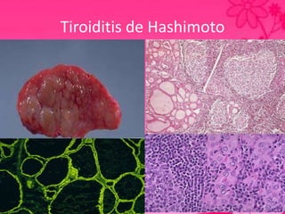 Tiroiditis Manual de endocrino | PPTX